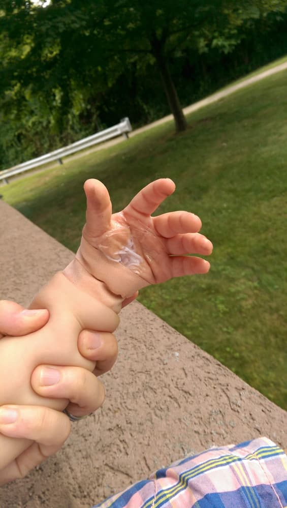 Numbing Cream on a Toddler Hand